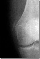 Pellegrini-Steida_lesion